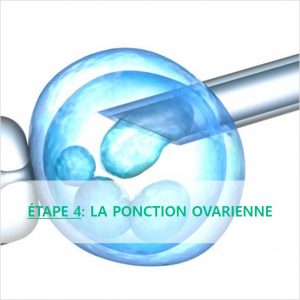 reproduction-assistee-ponction-ovarienne